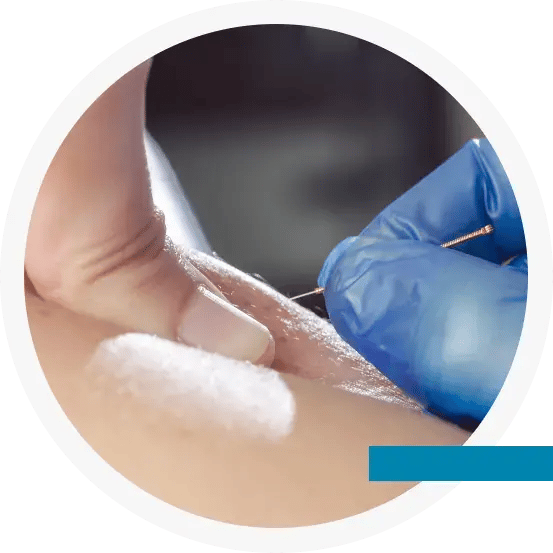 Acupuncture&DryNeedling_ProfesionalAdvantage