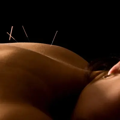 Biomedical Acupuncture  & Dry Needling